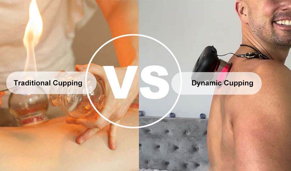 Traditional Cupping Vs Dynamic Cupping : Everything You Should Know